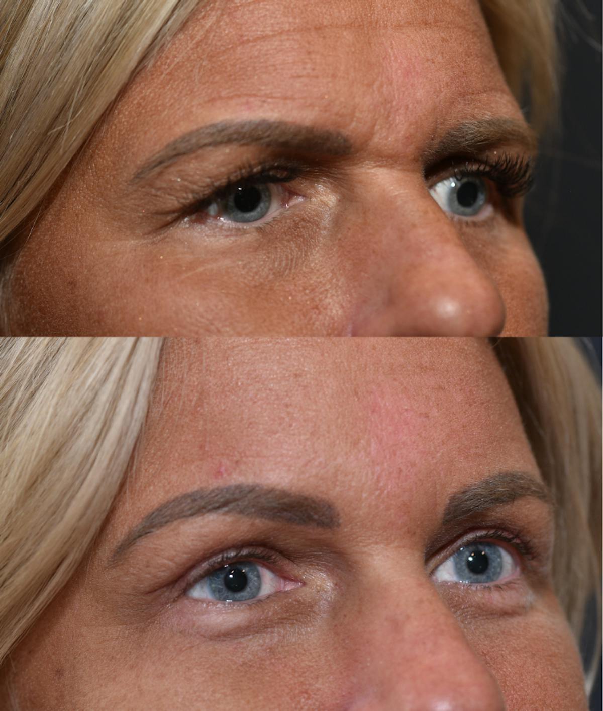 Endoscopic Brow Lift with Upper Blepharoplasty Before & After Gallery - Patient 205992 - Image 2