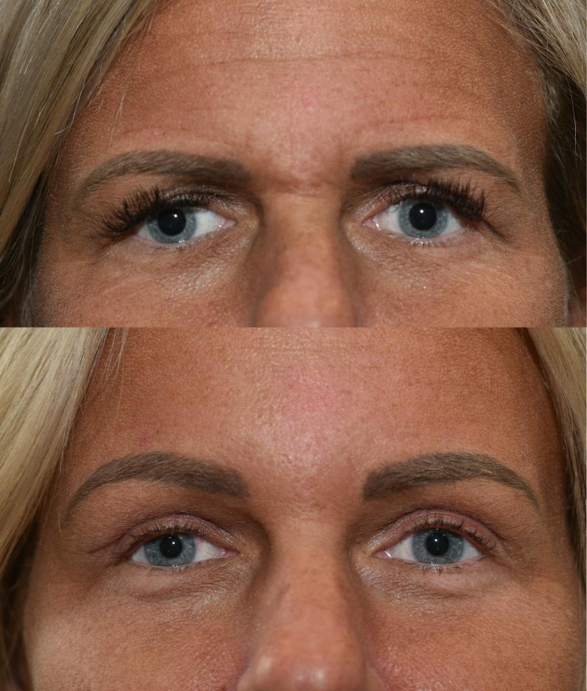 Endoscopic Brow Lift with Upper Blepharoplasty Before & After Gallery - Patient 205992 - Image 1