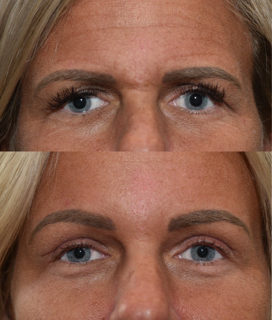 Endoscopic Brow Lift with Upper Blepharoplasty Before & After Gallery - Patient 205992 - Image 1