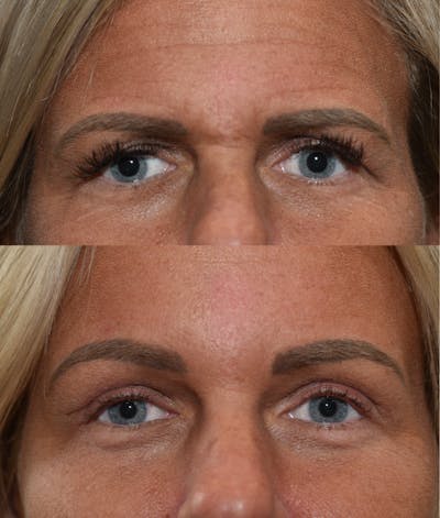 Endoscopic Brow Lift with Upper Blepharoplasty Before & After Gallery - Patient 205992 - Image 1