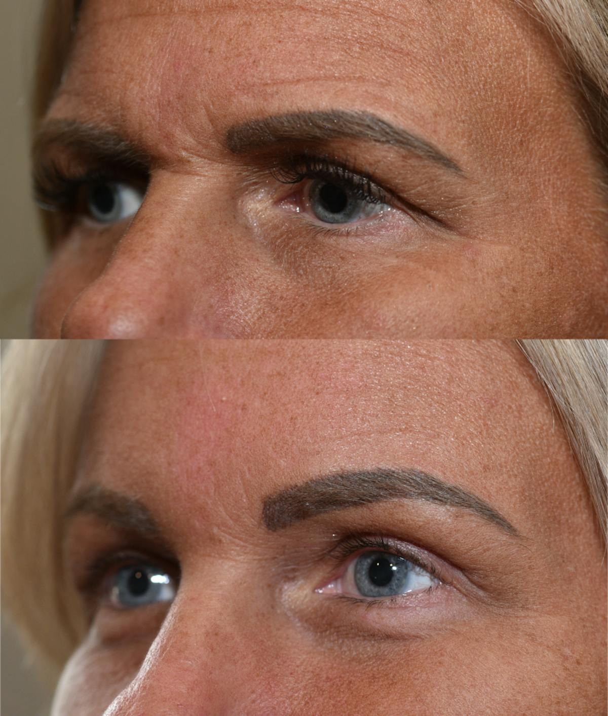 Endoscopic Brow Lift with Upper Blepharoplasty Before & After Gallery - Patient 205992 - Image 3