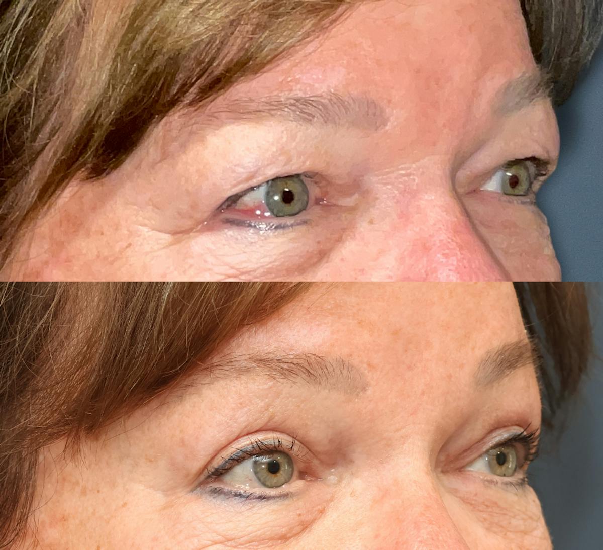 Ptosis Repair Before & After Gallery - Patient 249421 - Image 2