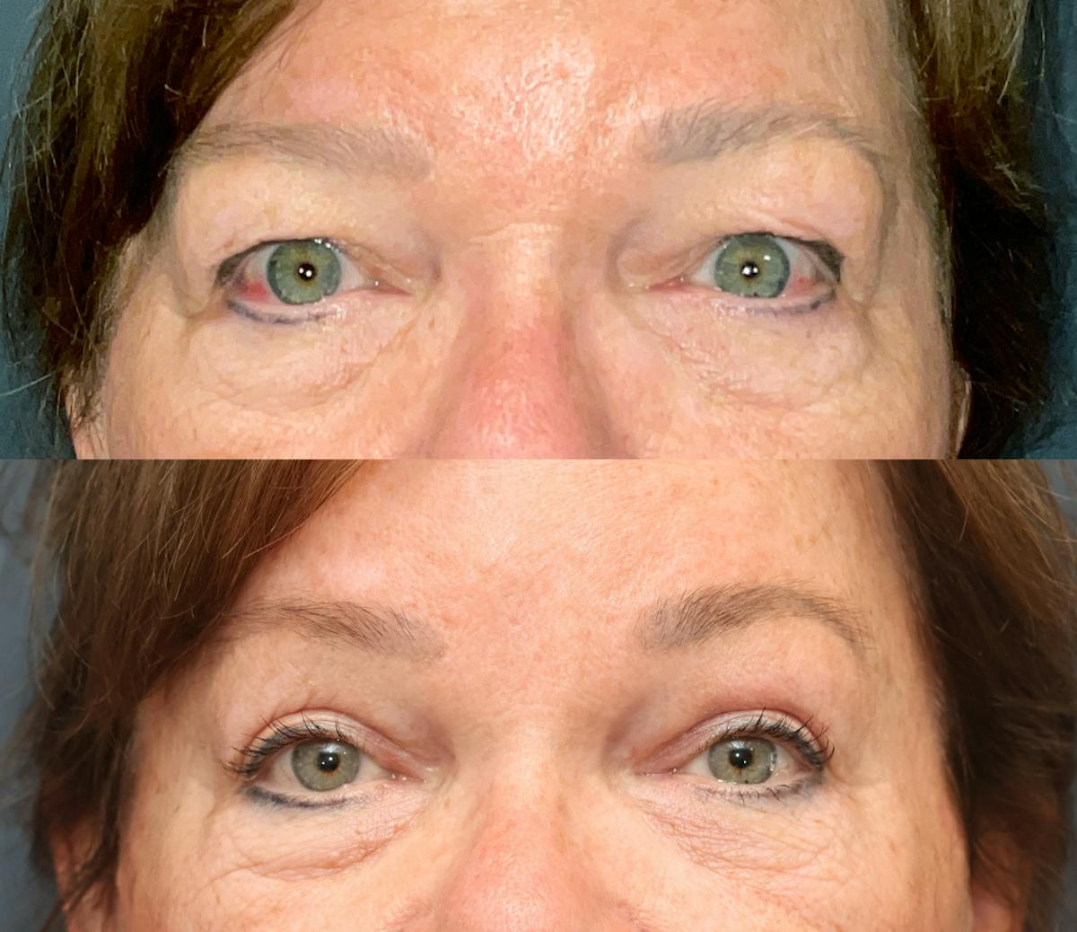 Ptosis Repair Before & After Gallery - Patient 249421 - Image 1