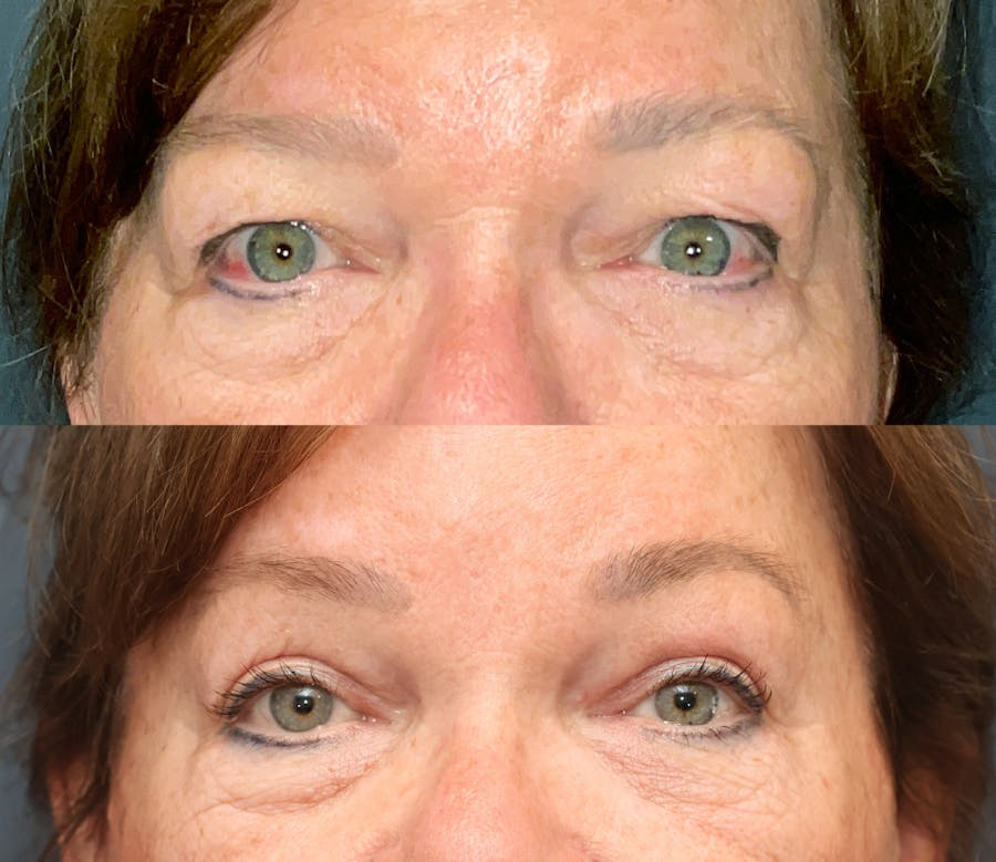 Endoscopic Brow Lift with Upper Blepharoplasty Before & After Gallery - Patient 417281 - Image 1