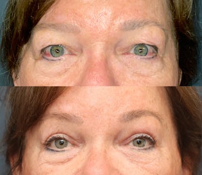 Endoscopic Brow Lift with Upper Blepharoplasty Before & After Gallery - Patient 417281 - Image 1