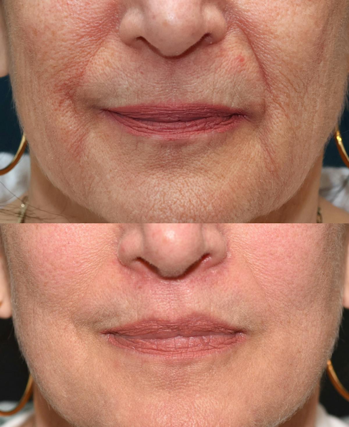 Lip Lift Before & After Gallery - Patient 416492 - Image 1
