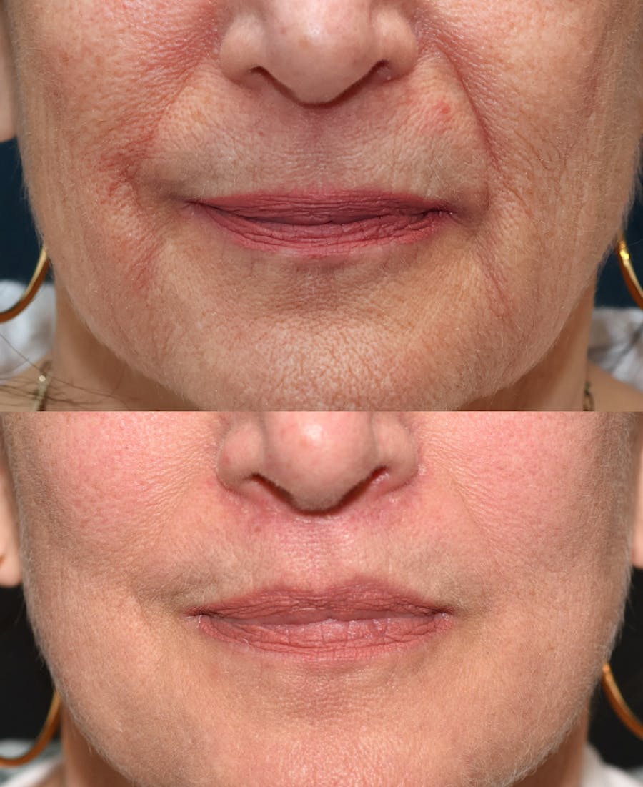 Lip Lift Before & After Gallery - Patient 416492 - Image 1