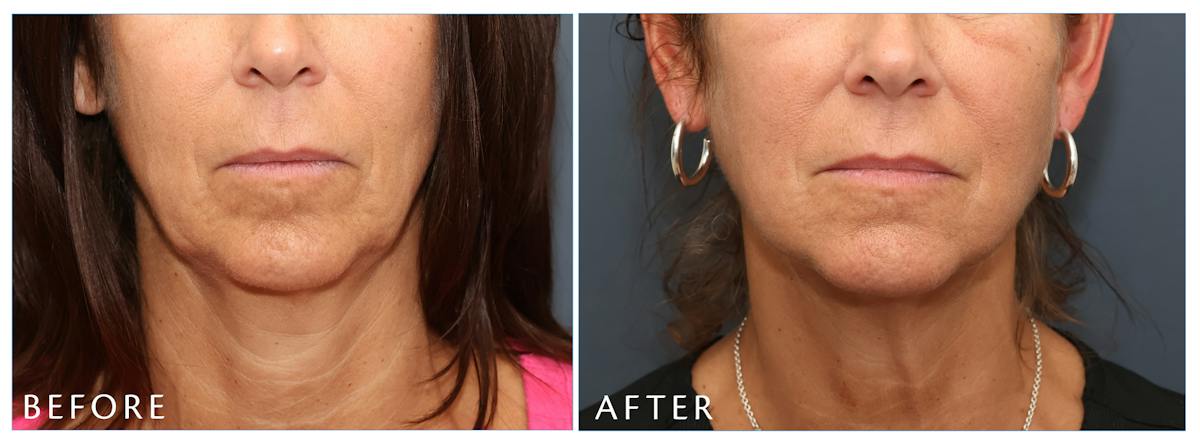 Junera Before & After Gallery - Patient 178535 - Image 3