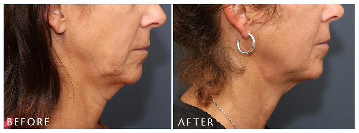 Junera Before & After Gallery - Patient 178535 - Image 2