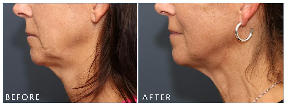 Junera Before & After Gallery - Patient 178535 - Image 1