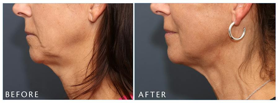 Junera Before & After Gallery - Patient 178535 - Image 1