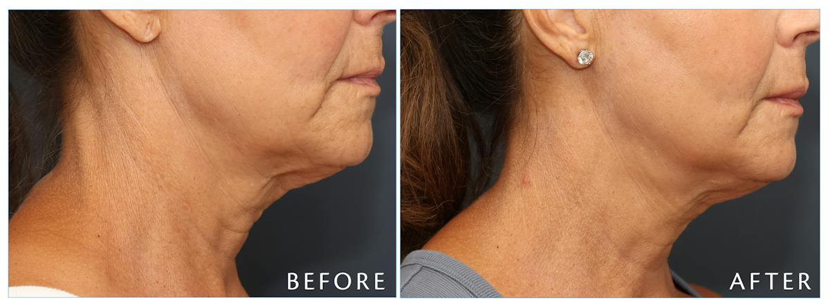 Junera Before & After Gallery - Patient 391567 - Image 3