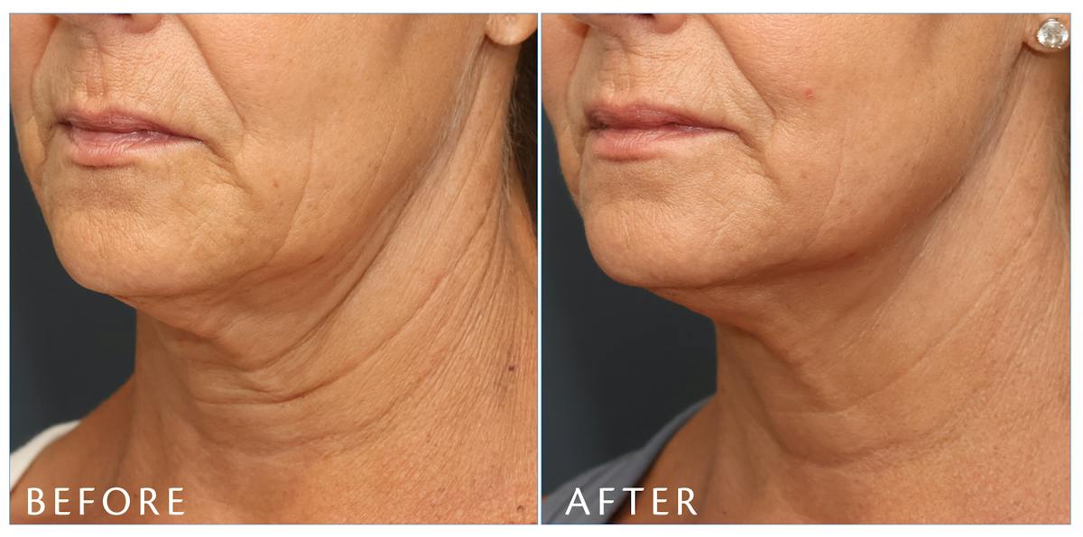 Junera Before & After Gallery - Patient 391567 - Image 2