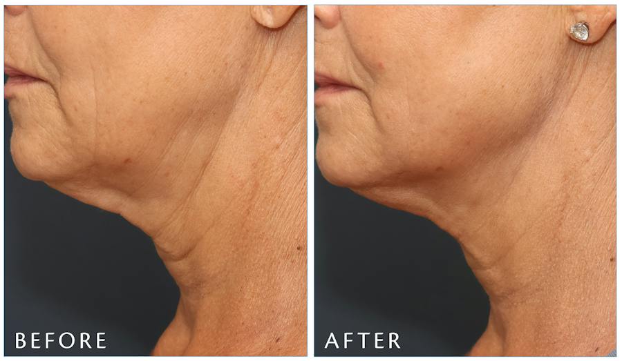 Junera Before & After Gallery - Patient 391567 - Image 1