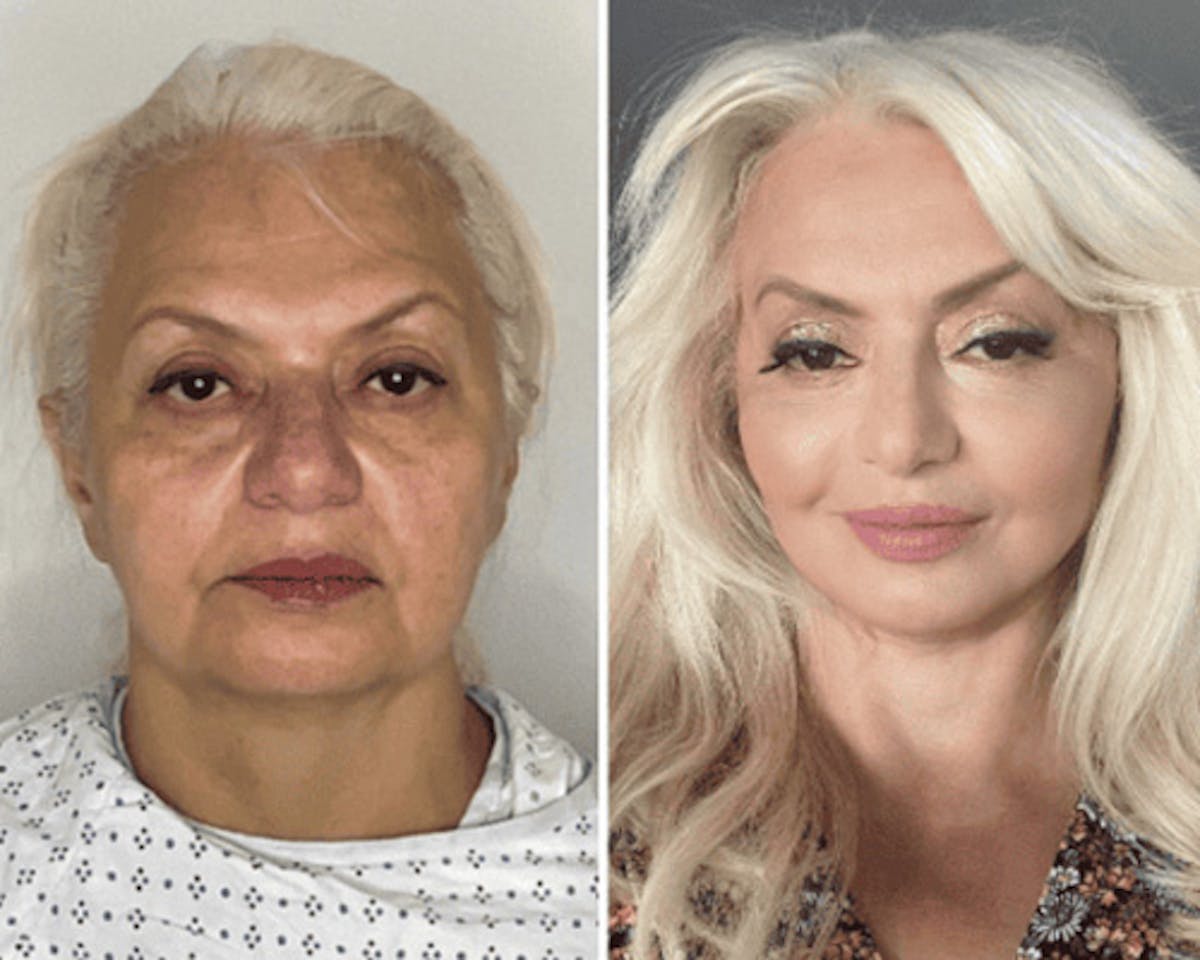 Deep Plane Facelift Before & After Gallery - Patient 221623 - Image 1