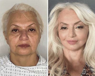 Deep Plane Facelift Before & After Gallery - Patient 221623 - Image 1