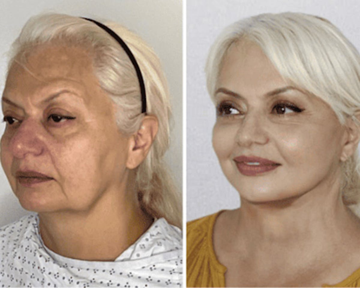 Deep Plane Facelift Before & After Gallery - Patient 221623 - Image 2