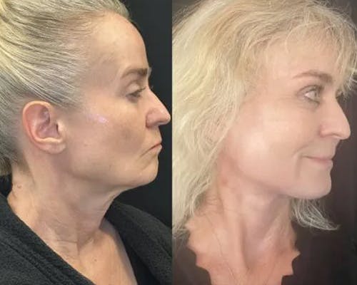 Deep Plane Facelift Before & After Gallery - Patient 130369 - Image 1