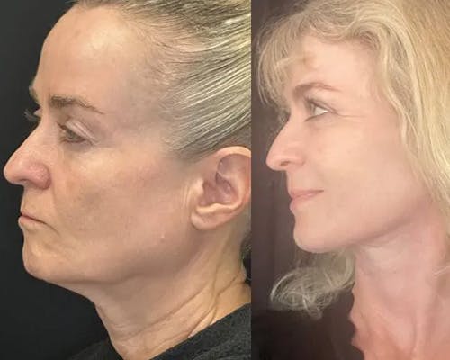 Deep Plane Facelift Before & After Gallery - Patient 130369 - Image 2
