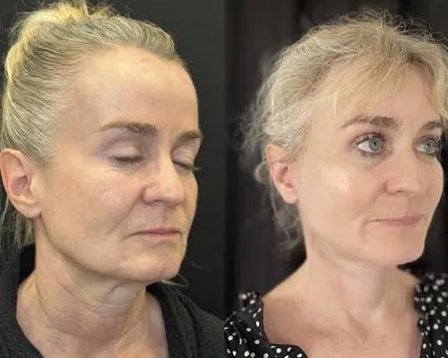 Deep Plane Facelift Before & After Gallery - Patient 130369 - Image 3