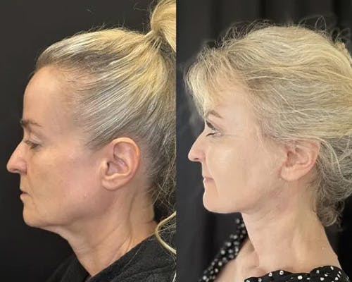 Deep Plane Facelift Before & After Gallery - Patient 130369 - Image 4