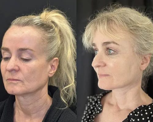 Deep Plane Facelift Before & After Gallery - Patient 130369 - Image 5