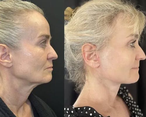 Deep Plane Facelift Before & After Gallery - Patient 130369 - Image 6