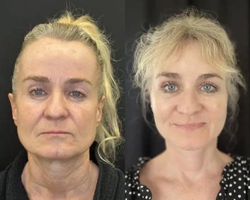 Deep Plane Facelift Before & After Gallery - Patient 130369 - Image 7