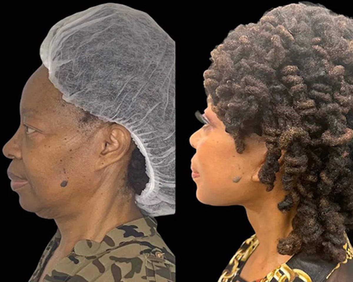 Ethnic Facelift Before & After Gallery - Patient 165021 - Image 1