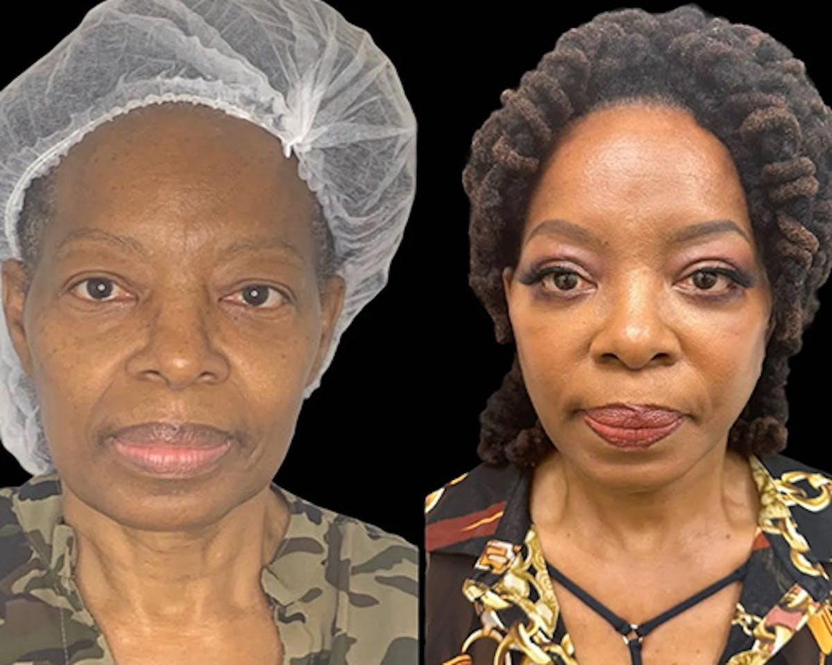 Ethnic Facelift Before & After Gallery - Patient 165021 - Image 2