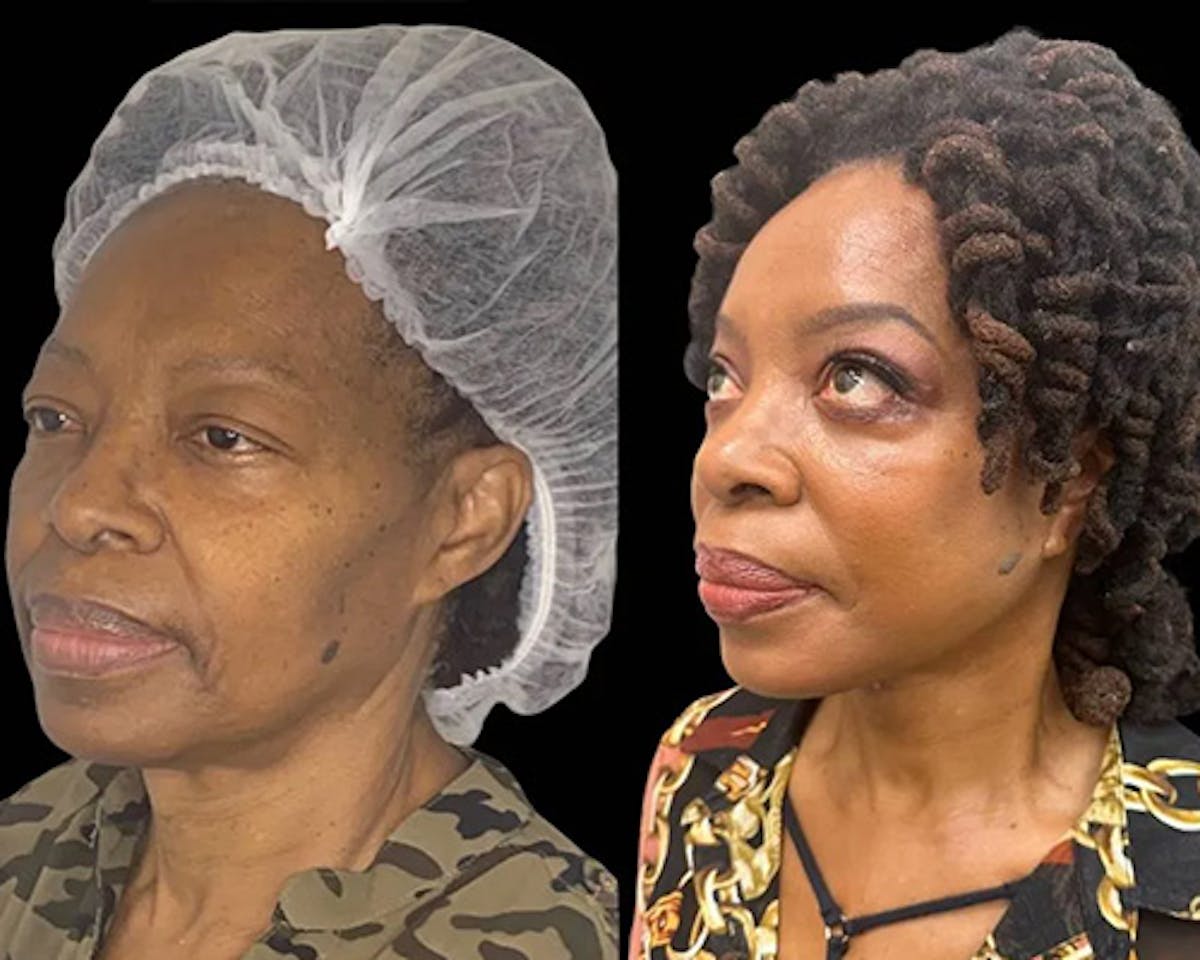 Ethnic Facelift Before & After Gallery - Patient 165021 - Image 3