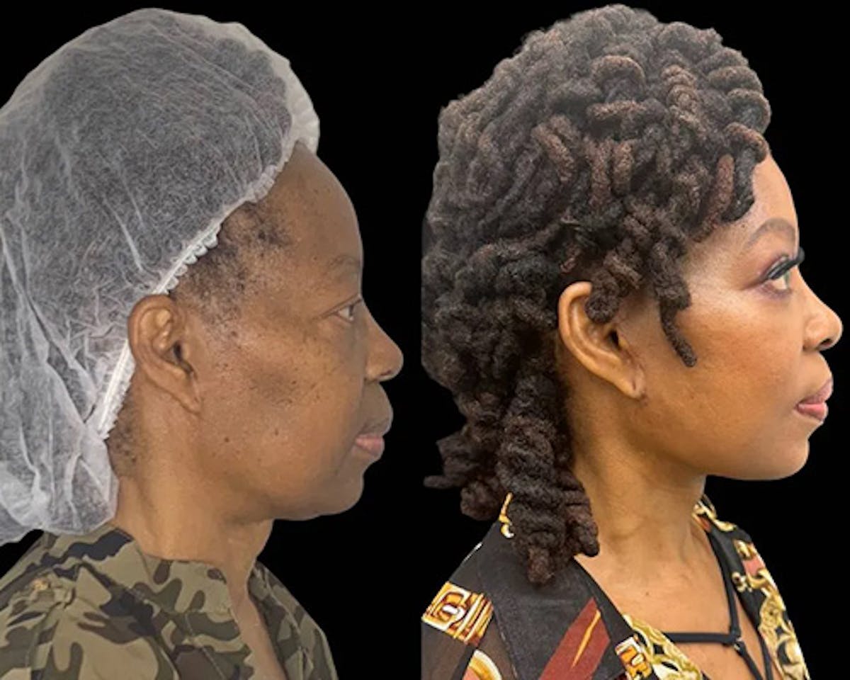 Ethnic Facelift Before & After Gallery - Patient 165021 - Image 4