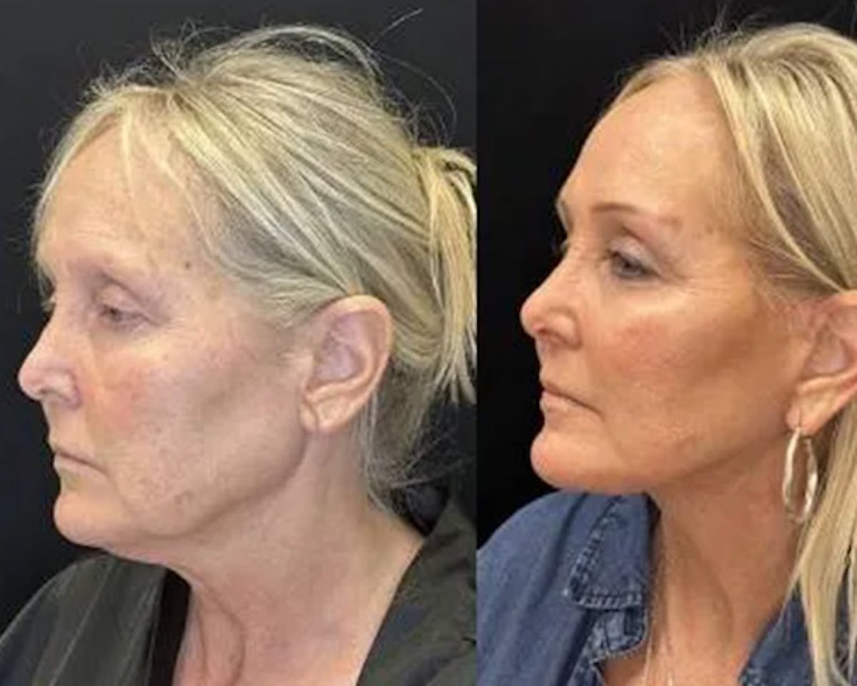Deep Plane Facelift Before & After Gallery - Patient 185901 - Image 1