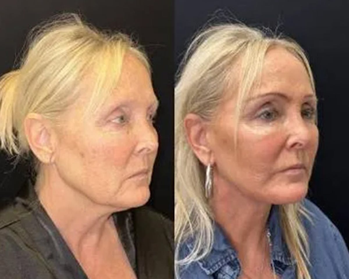 Deep Plane Facelift Before & After Gallery - Patient 185901 - Image 2