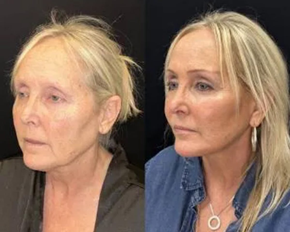 Deep Plane Facelift Before & After Gallery - Patient 185901 - Image 3