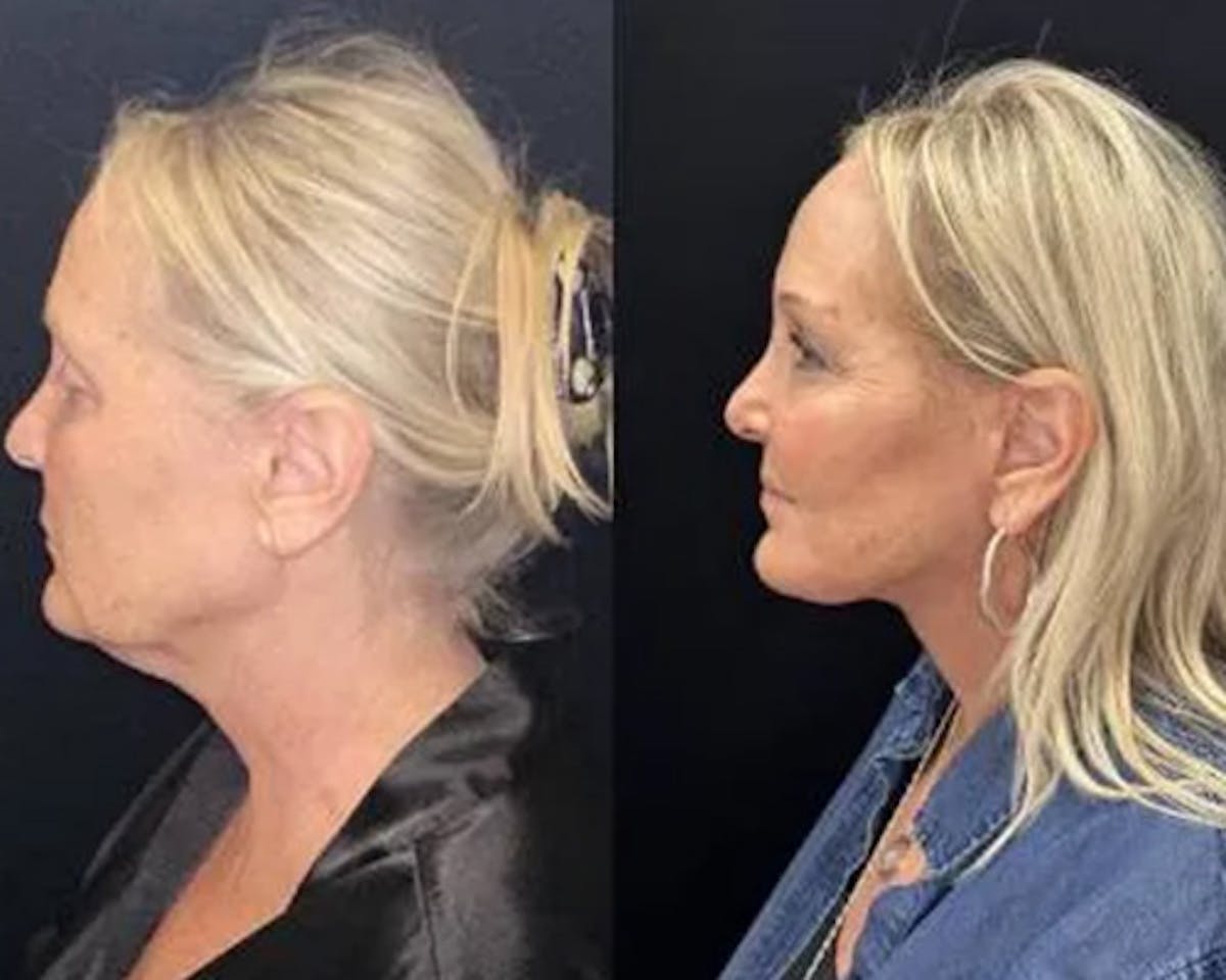 Deep Plane Facelift Before & After Gallery - Patient 185901 - Image 4
