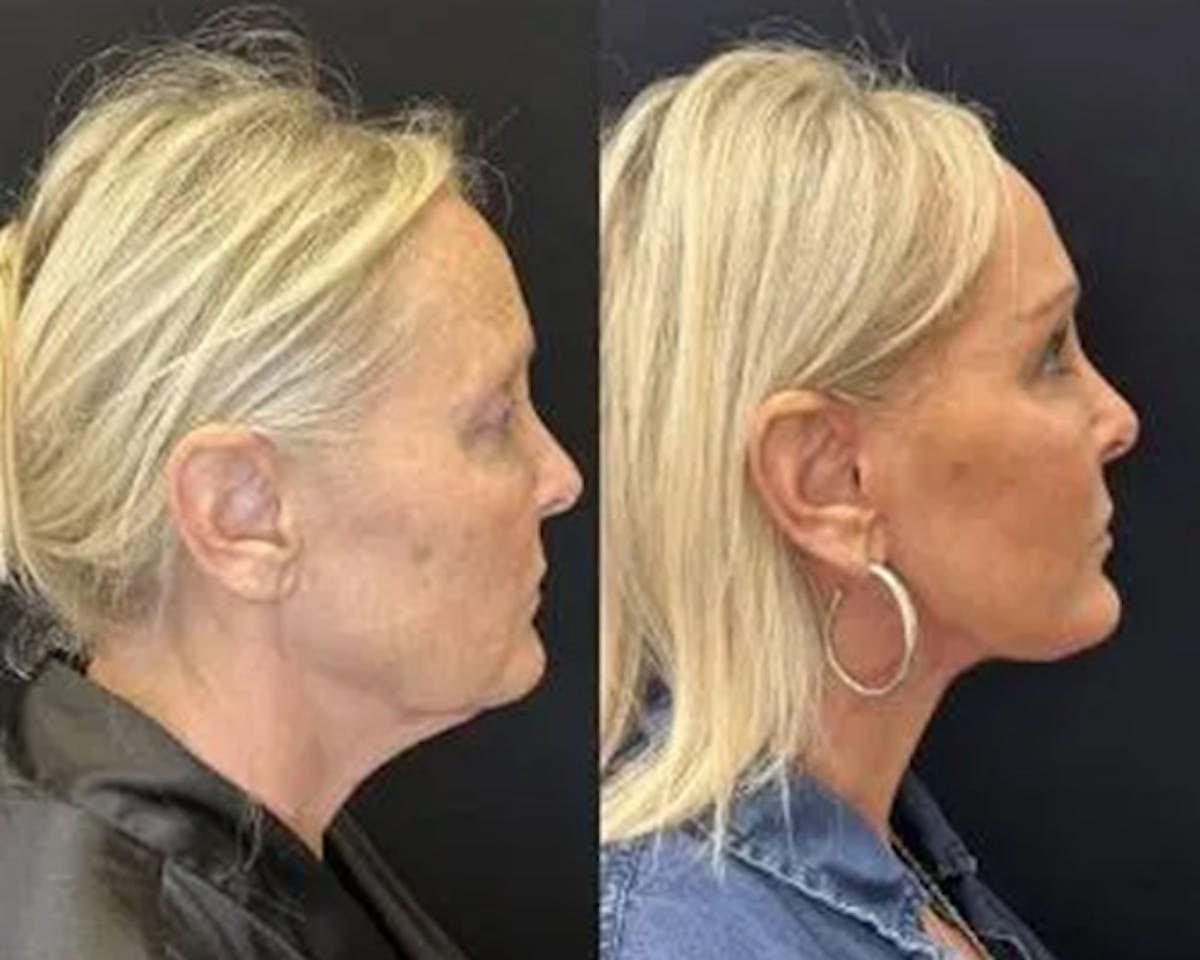Deep Plane Facelift Before & After Gallery - Patient 185901 - Image 5