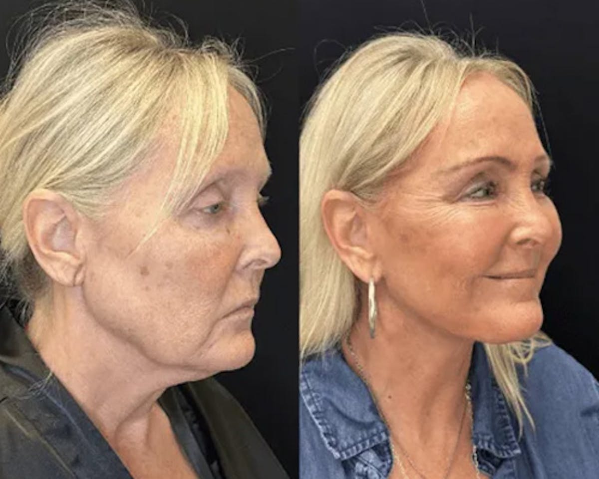 Deep Plane Facelift Before & After Gallery - Patient 185901 - Image 6