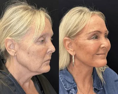 Deep Plane Facelift Before & After Gallery - Patient 185901 - Image 6