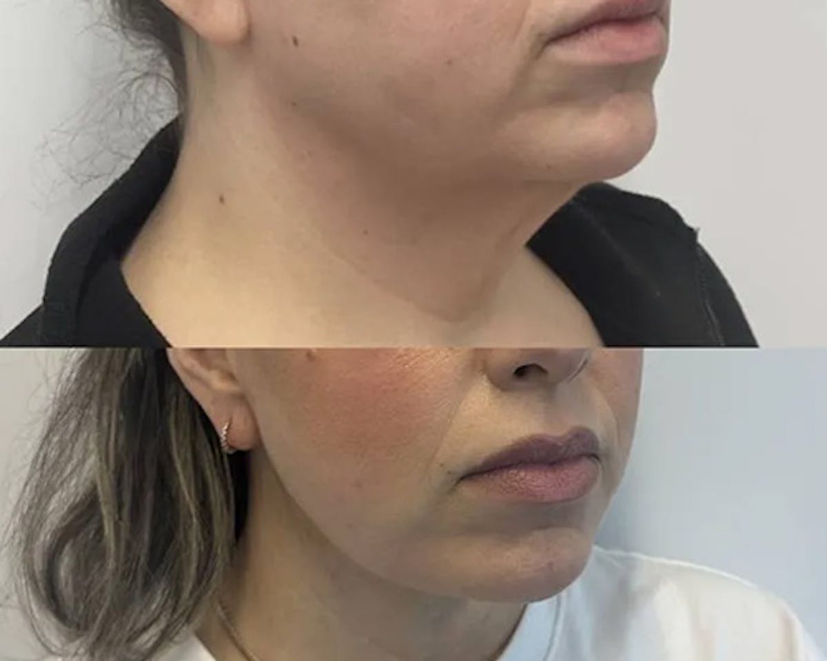 Facelift After Weight Loss Before & After Gallery - Patient 137937 - Image 1