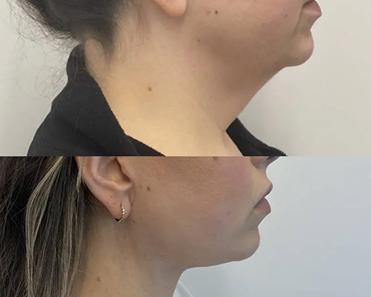 Facelift After Weight Loss Before & After Gallery - Patient 137937 - Image 2