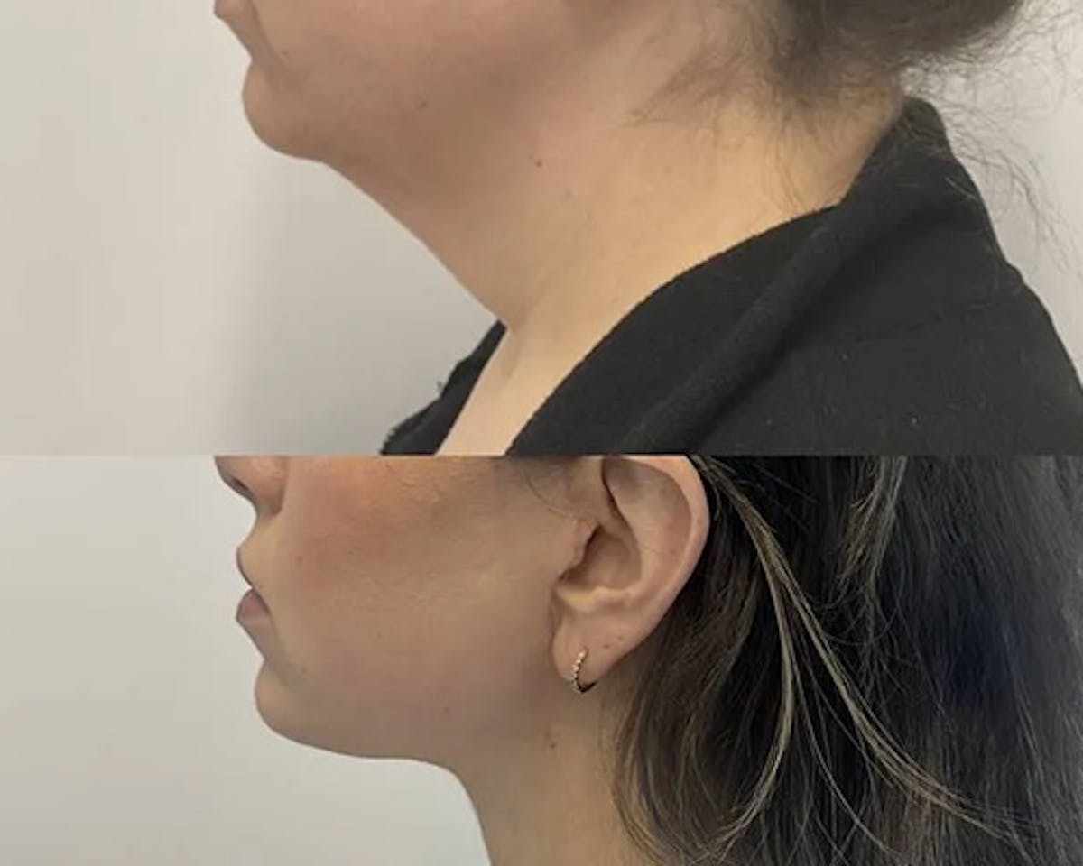 Facelift After Weight Loss Before & After Gallery - Patient 137937 - Image 3