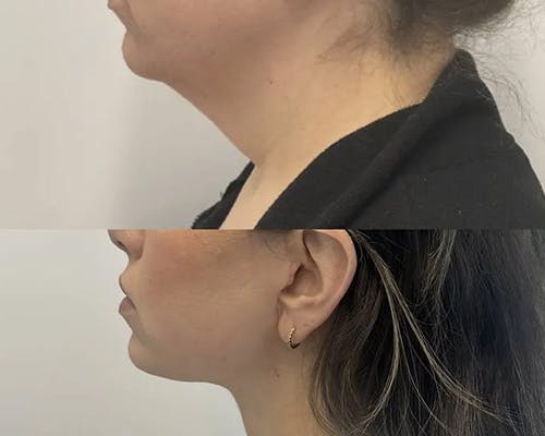 Deep Plane Facelift Before & After Gallery - Patient 326647 - Image 3