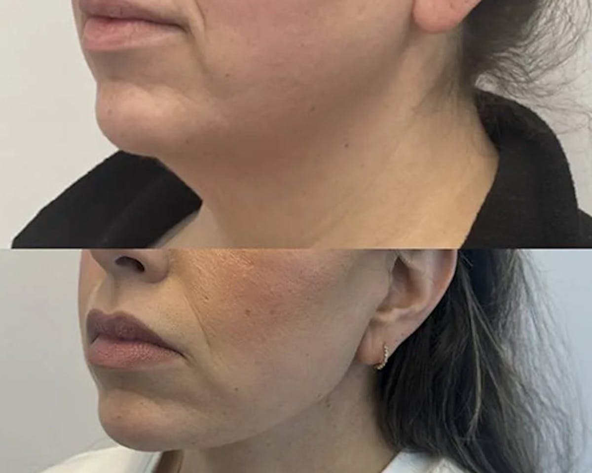 Facelift After Weight Loss Before & After Gallery - Patient 137937 - Image 4
