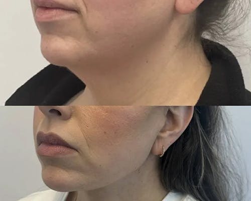 Deep Plane Facelift Before & After Gallery - Patient 326647 - Image 4