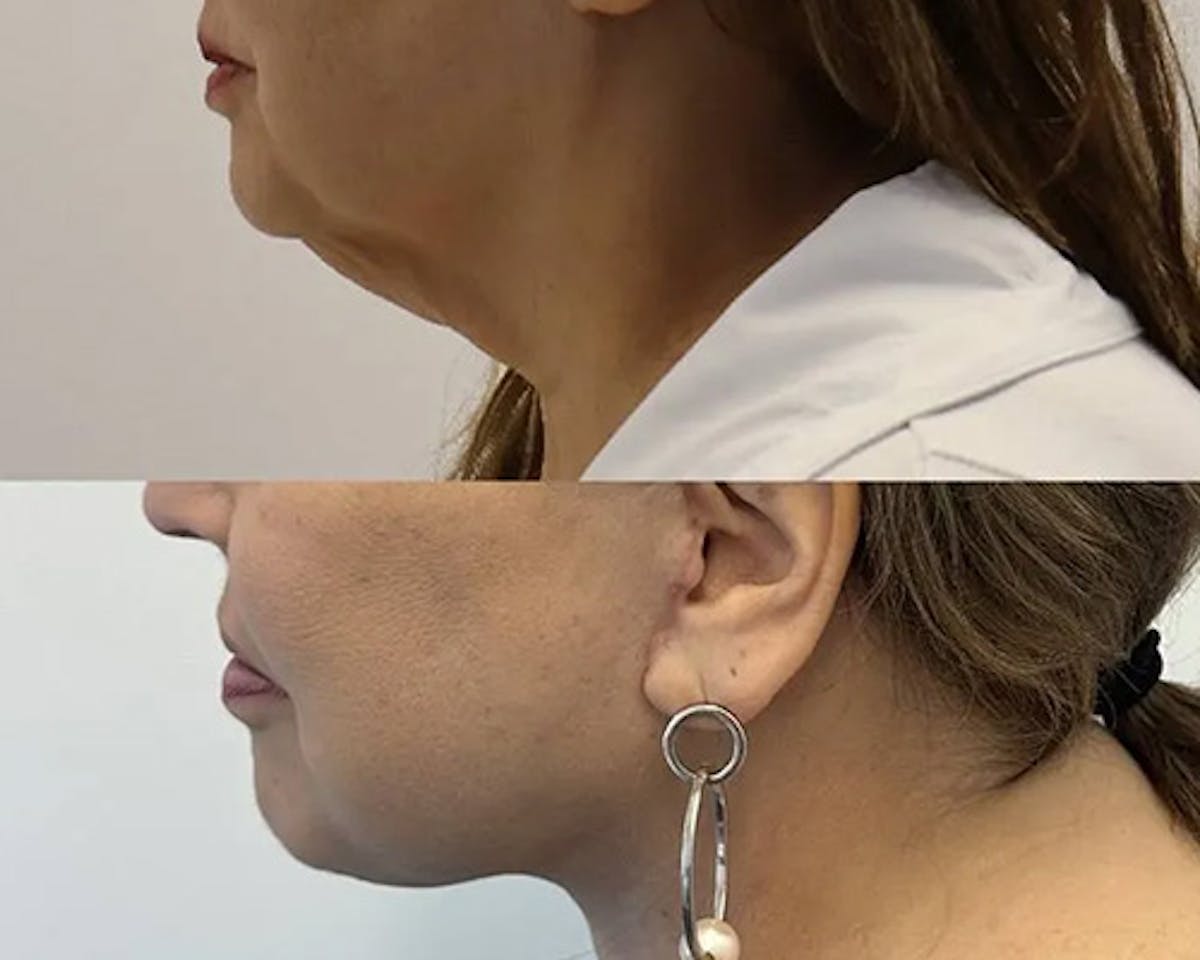 Ethnic Facelift Before & After Gallery - Patient 162284 - Image 1