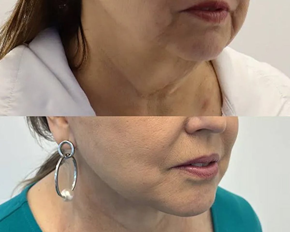 Ethnic Facelift Before & After Gallery - Patient 162284 - Image 2