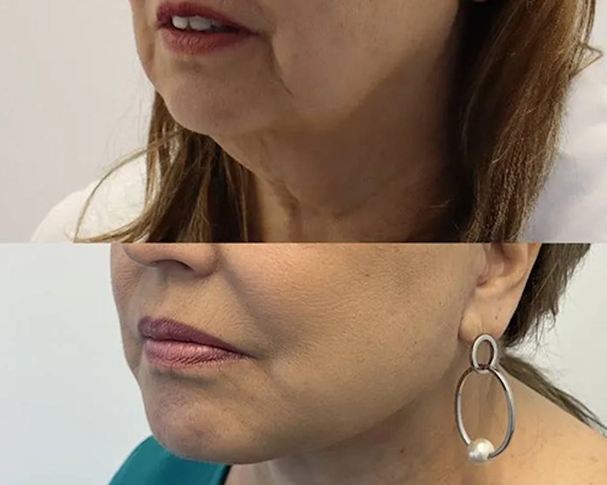 Ethnic Facelift Before & After Gallery - Patient 162284 - Image 3