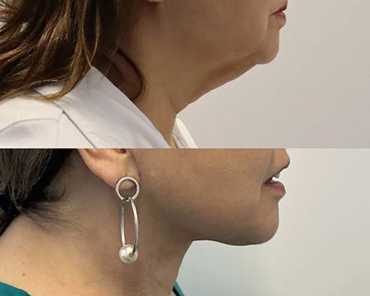 Ethnic Facelift Before & After Gallery - Patient 162284 - Image 4