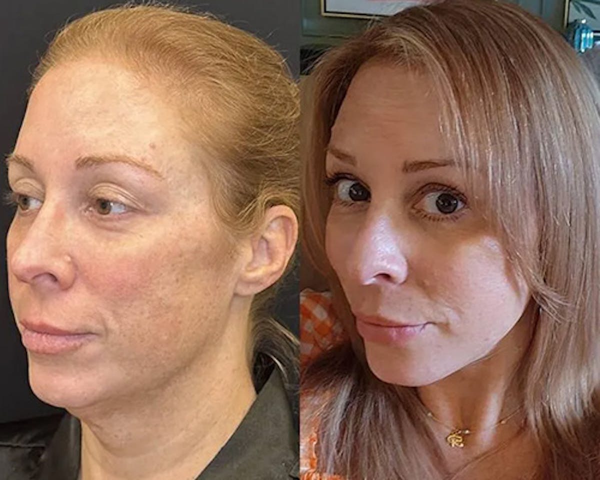 Deep Plane Facelift Before & After Gallery - Patient 199709 - Image 1